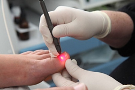 Corectie laser (Tratament lase